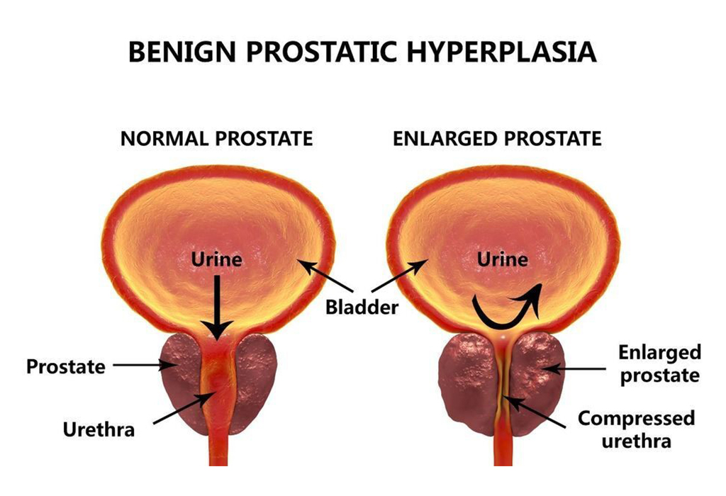 Erectile Dysfunction