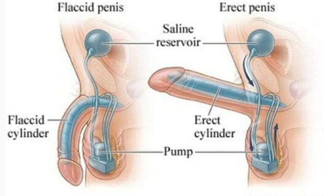 Erectile Dysfunction
