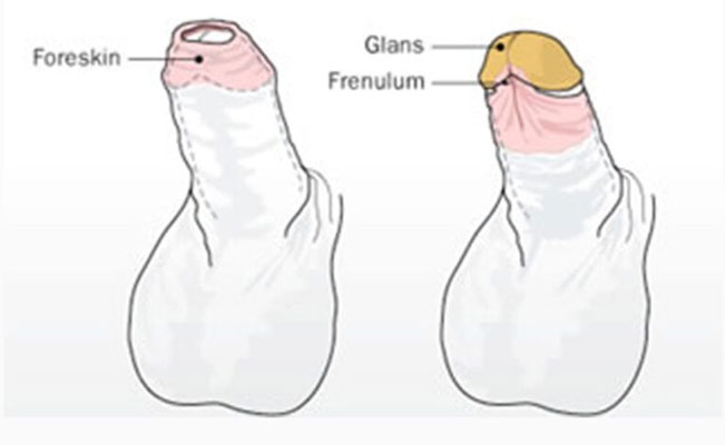 Tight Foreskin Treatment